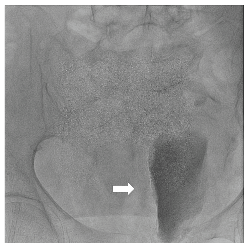 Bladder-sign-showing-the-contrast-filled-bladder-pushed-to-the-left,-implying-a-massive-right-retroperitoneal-hemorrhage-(arrow)