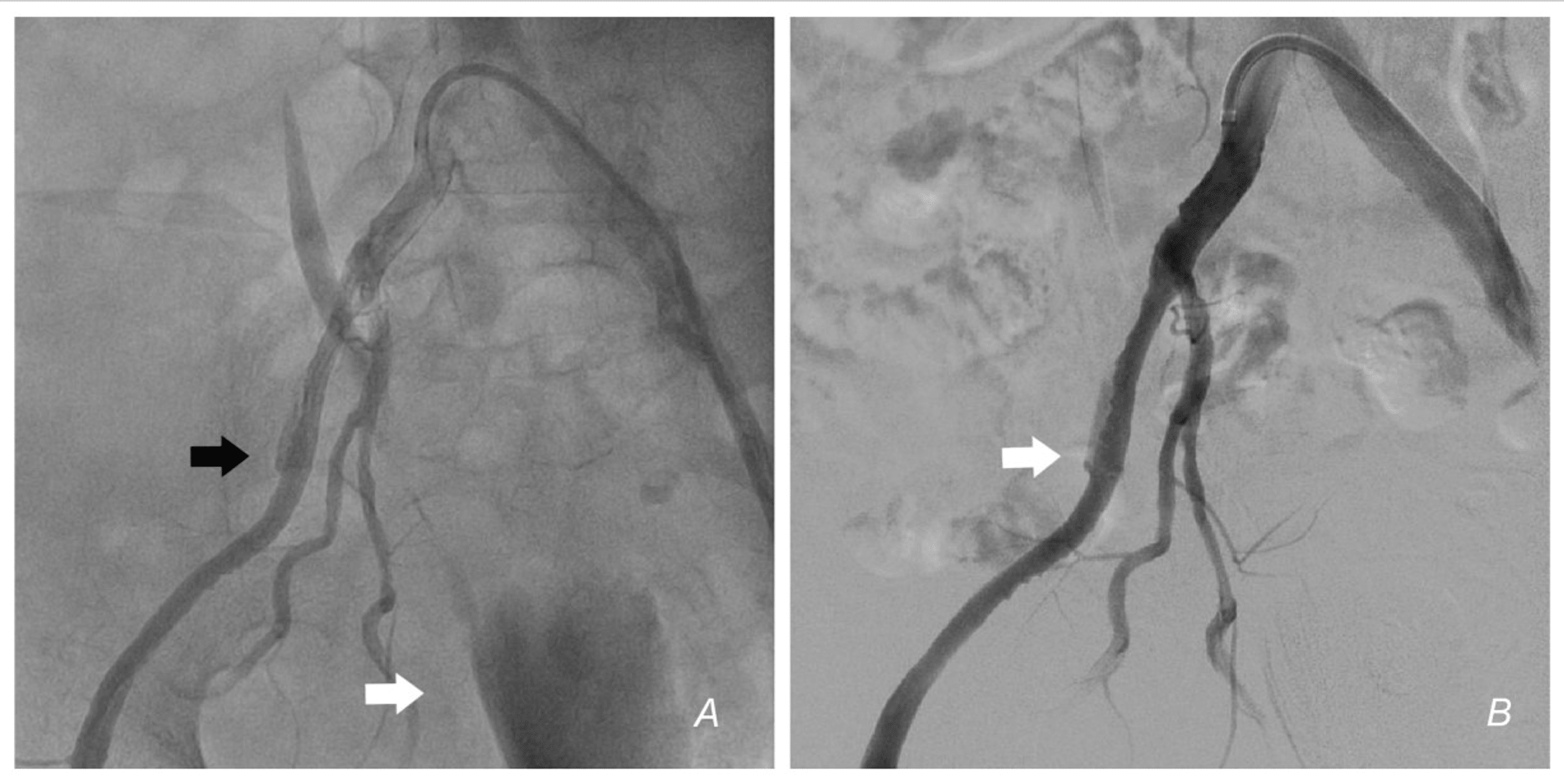 Cureus Management Of Iatrogenic External Iliac Artery Perforation With A Self Made Covered Stent 