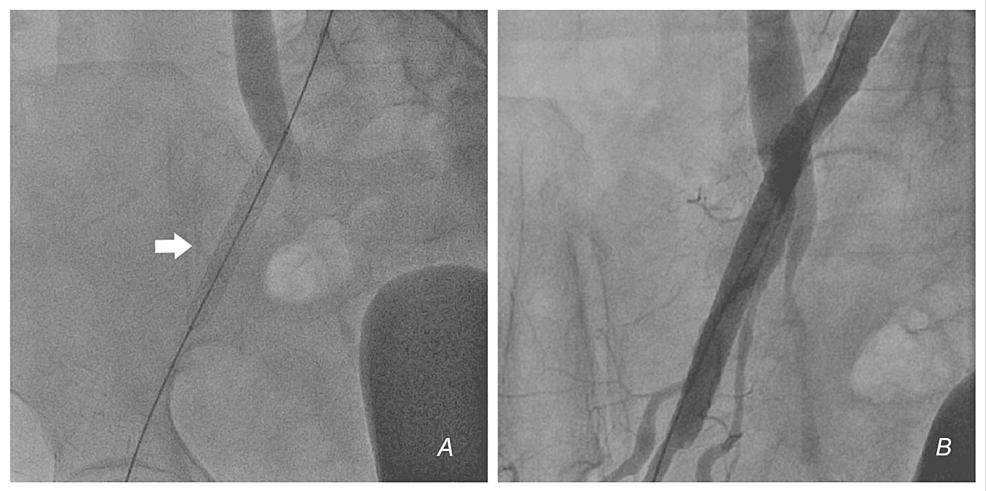 Deployment-of-self-made-covered-stent