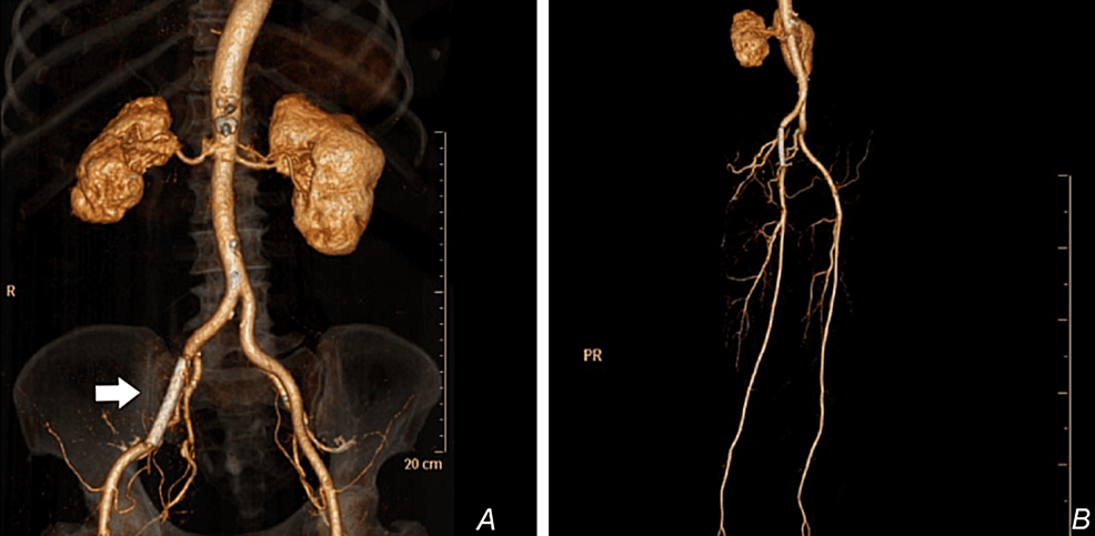Post-procedure-reconstructed-CT-angiogram-of-the-lower-limbs