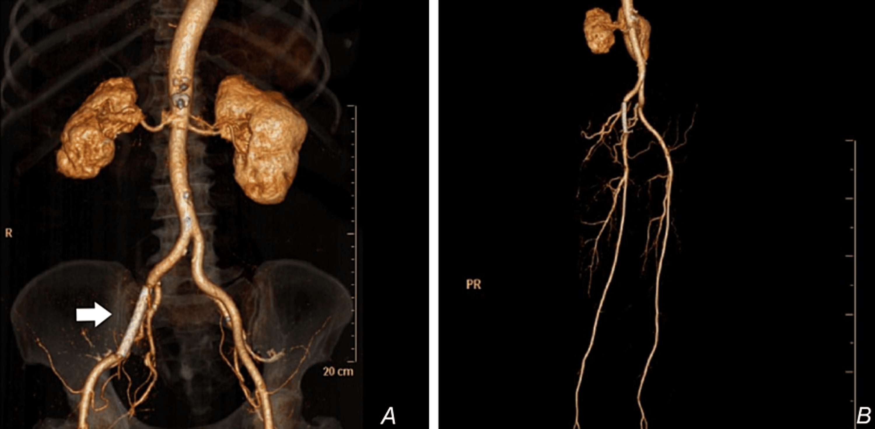 Cureus | Management of Iatrogenic External Iliac Artery Perforation ...