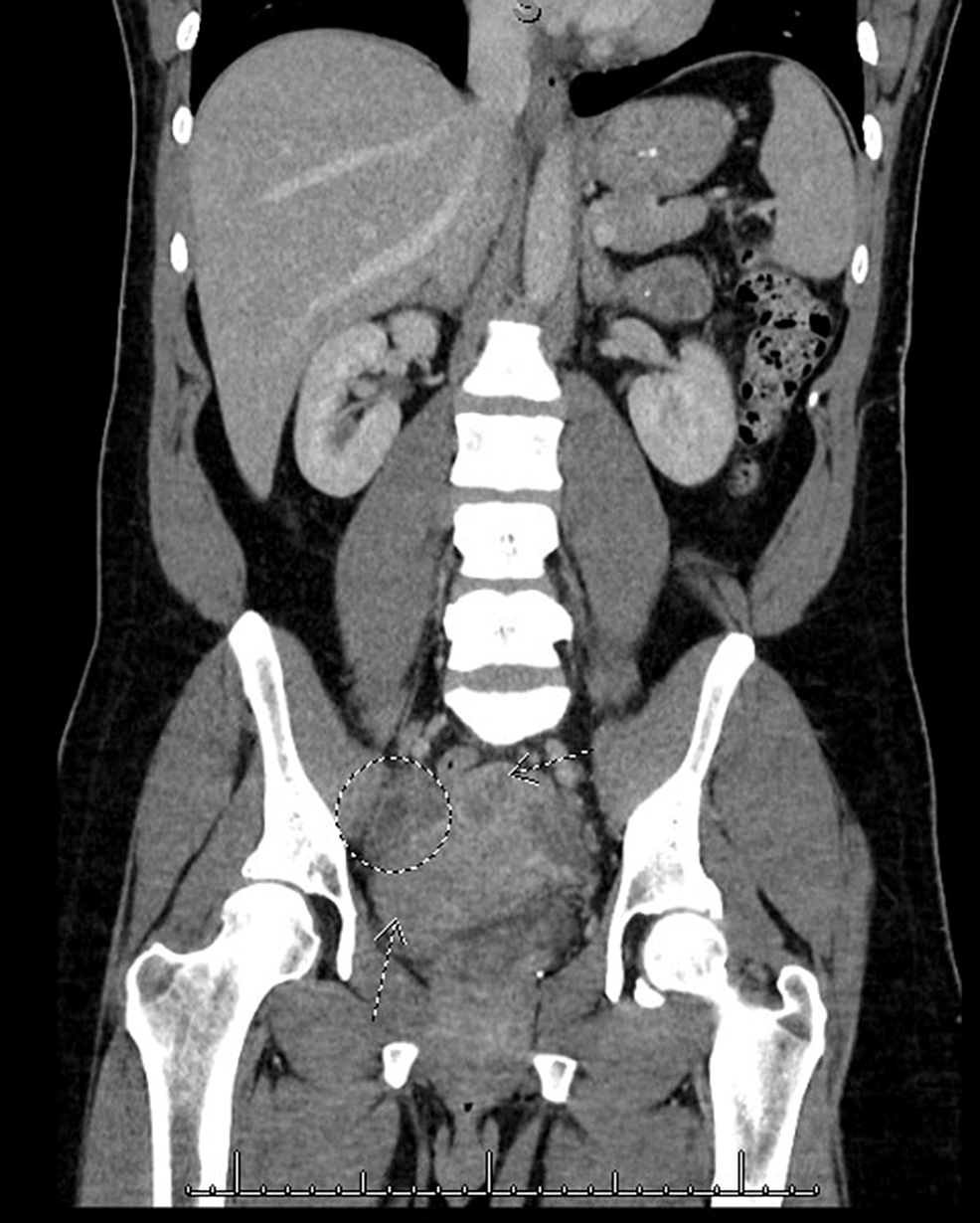 A Report of Haemophilus influenzae Bacteremia With Acute Pelvic ...