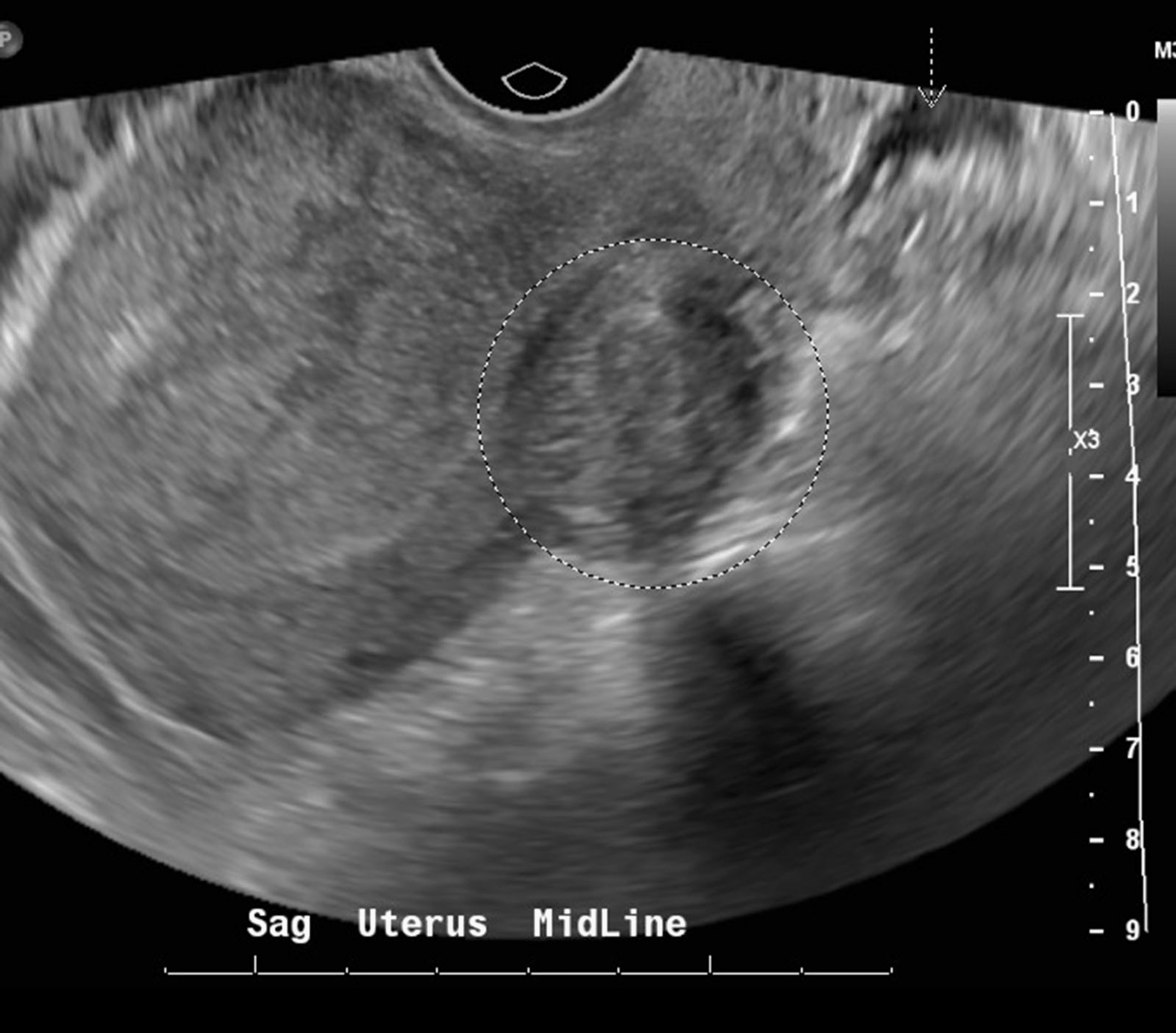 Acute Pelvic Inflammatory Disease image
