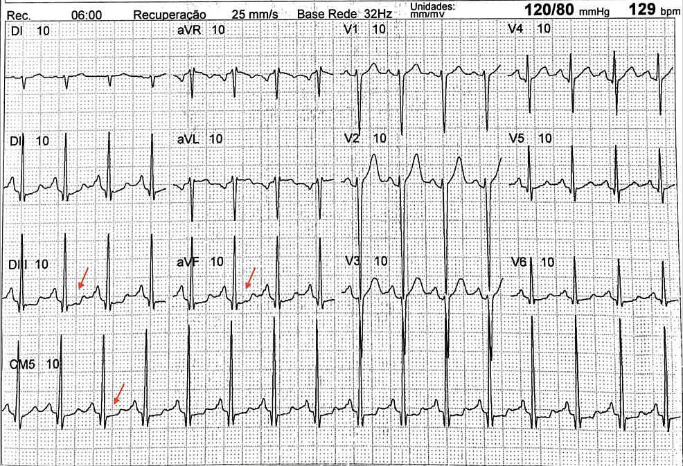 Cureus | Origin, Course, and Angulation of Coronary Artery Anomaly - A ...