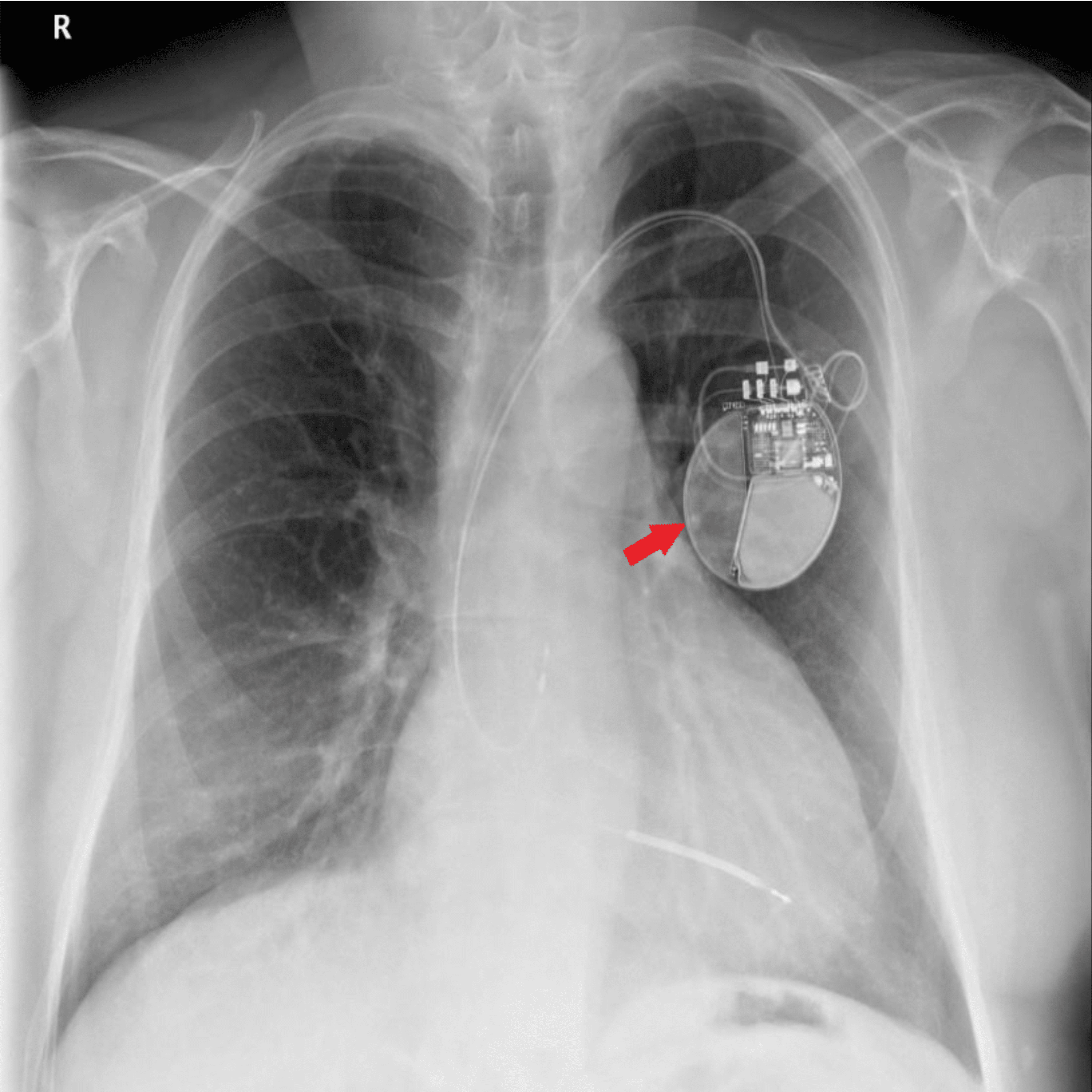 Cureus | Arrhythmogenic Cardiomyopathy: A Review of a Rare Case of ...