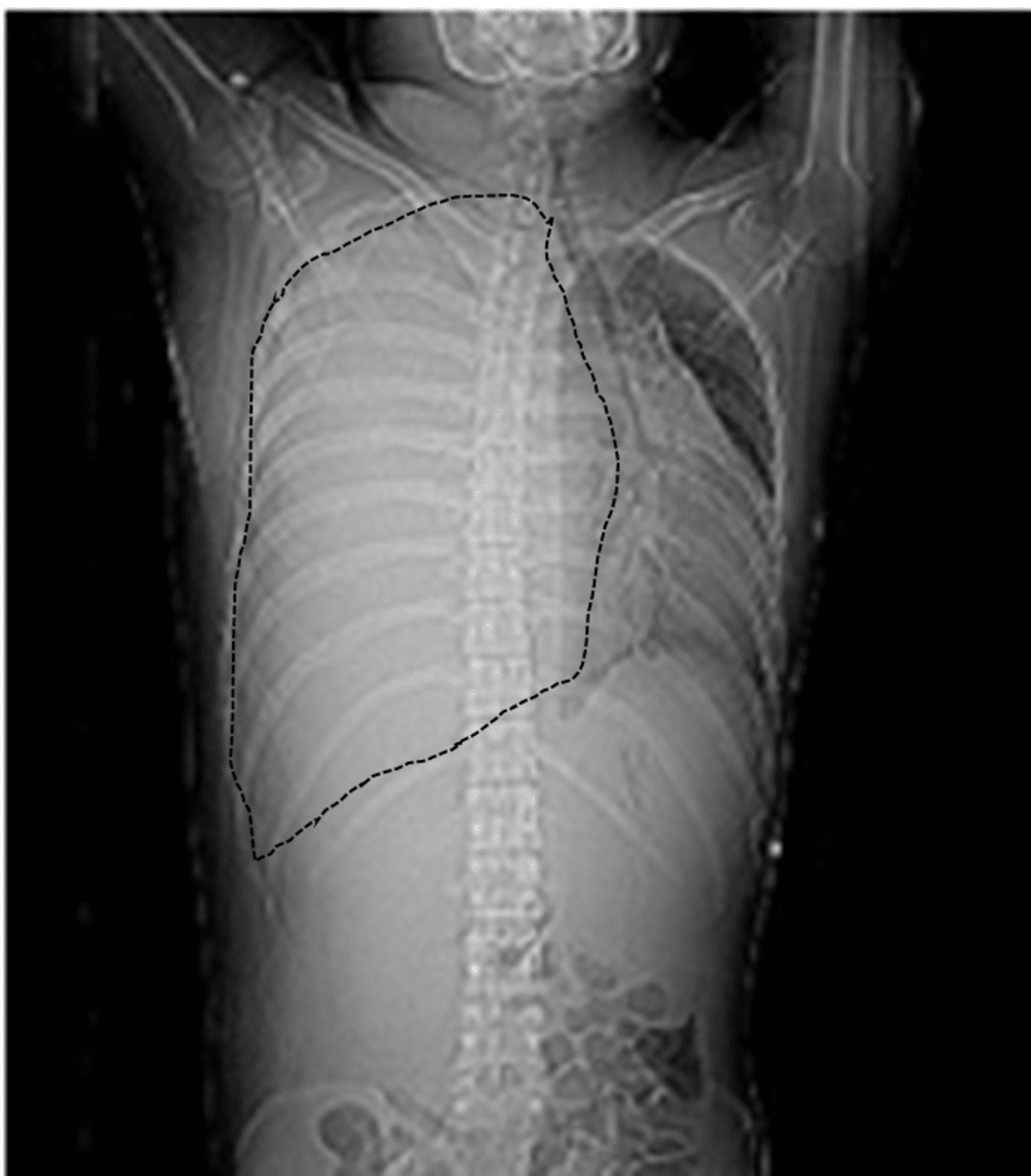 Cureus Superior Vena Cava Syndrome Secondary To The Largest Reported 
