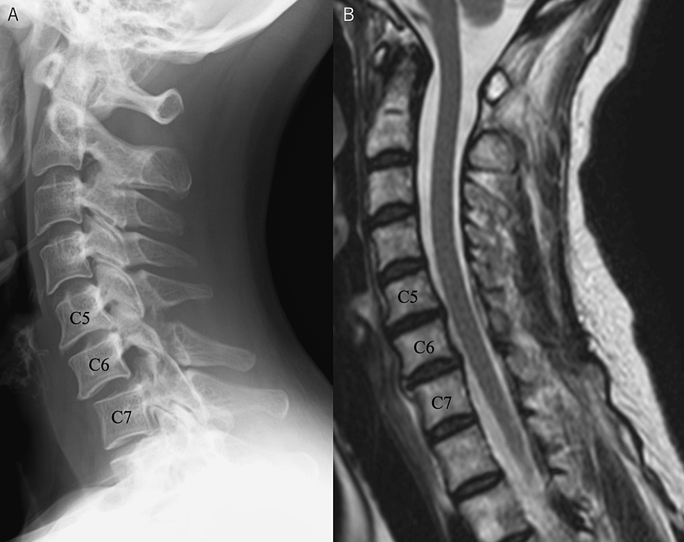 cureus-cervical-implant-allergy-with-chronic-neck-pain-a-case-report