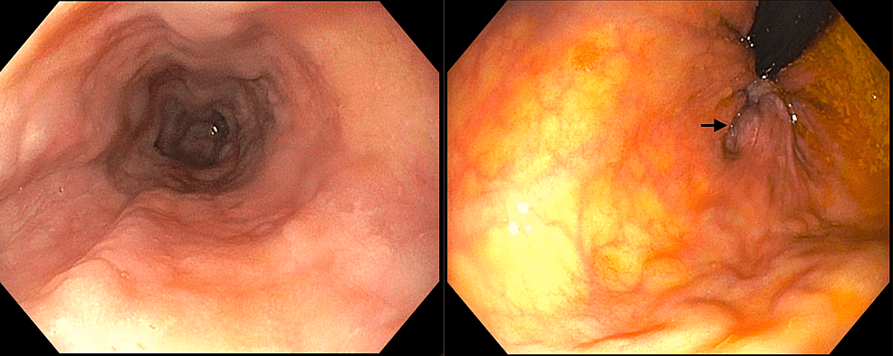 Anorectal bleeding is the second most common site of lower gastrointestinal bleeding. Colonoscopy remains the gold standard test to localize sources of lower gastrointestinal bleeding, but it can miss left-sided colon pathologies such as diverticula, rectal varices, and internal hemorrhoids. We report an unusual case of a male cirrhotic patient with massive hemorrhoidal bleeding which went undiagnosed despite multiple imaging and endoscopic evaluations. He underwent urgent sigmoidoscopy that identified grade III internal hemorrhoids and sclerotherapy which resolved the hematochezia. Decompensated cirrhosis complicates patient candidacy for surgical hemorrhoidectomy, but sclerotherapy is a viable option even for high-risk patients. Urgent sigmoidoscopy during active bleeding should be considered if hemorrhoidal bleeding is suspected but inconclusive by colonoscopy.