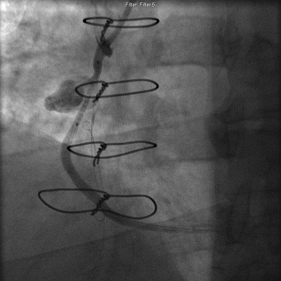 Cureus | Saphenous Vein Graft Pseudoaneurysm Repair With GraftMaster®