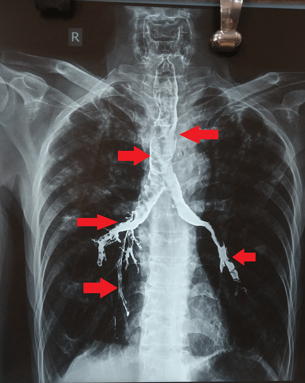Post-barium-swallow-chest-radiograph-(P-A-view)