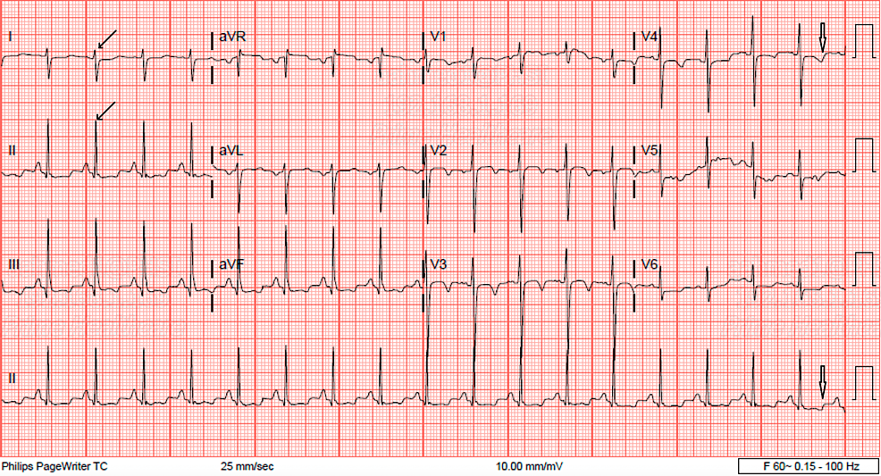 Cureus | Diabetic Ketoacidosis-Induced Cardiomyopathy and Reversible ...