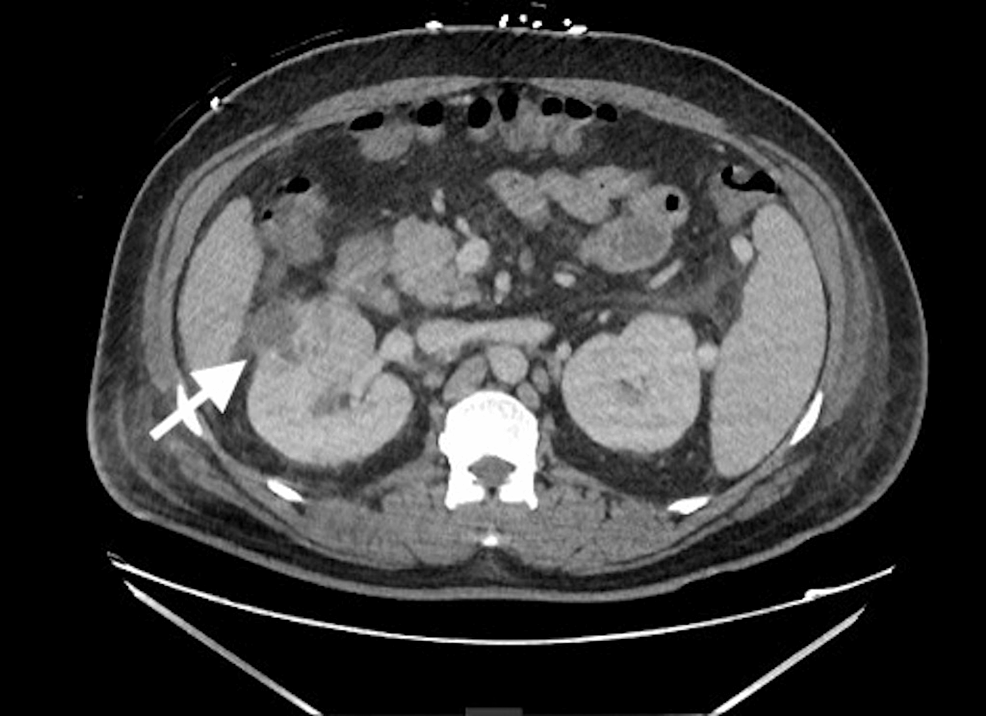 Klebsiella pneumoniae Infection as a Mimicker of Multiple Metastatic ...