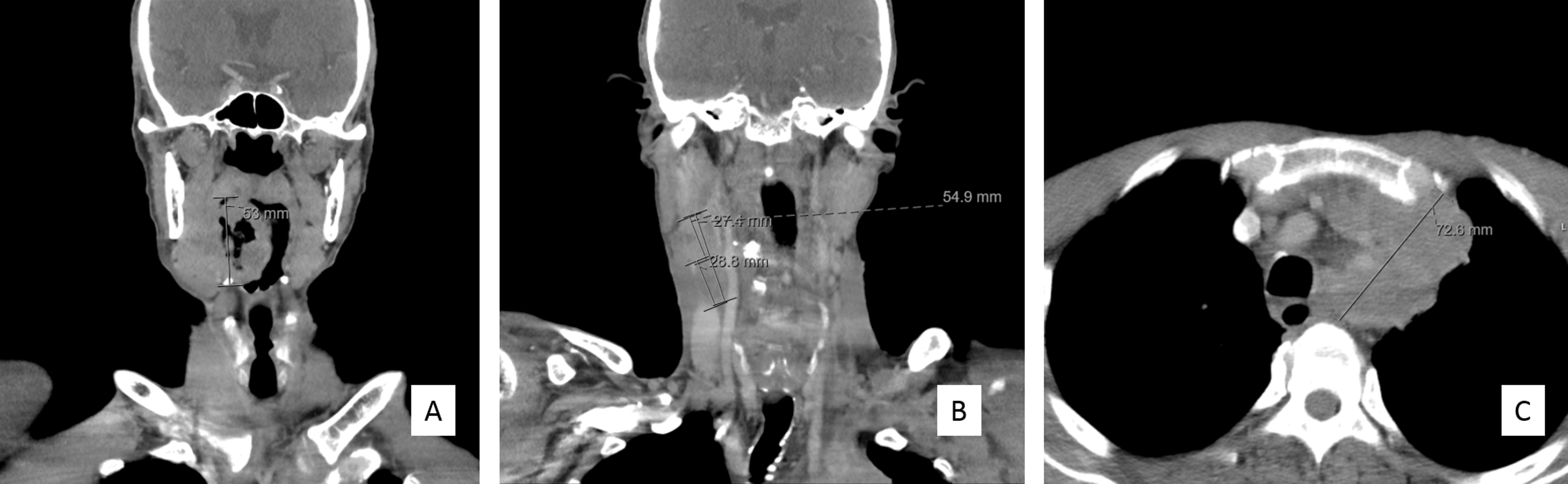 Cureus | Basaloid Squamous Cell Carcinoma, an Aggressive and Rare ...