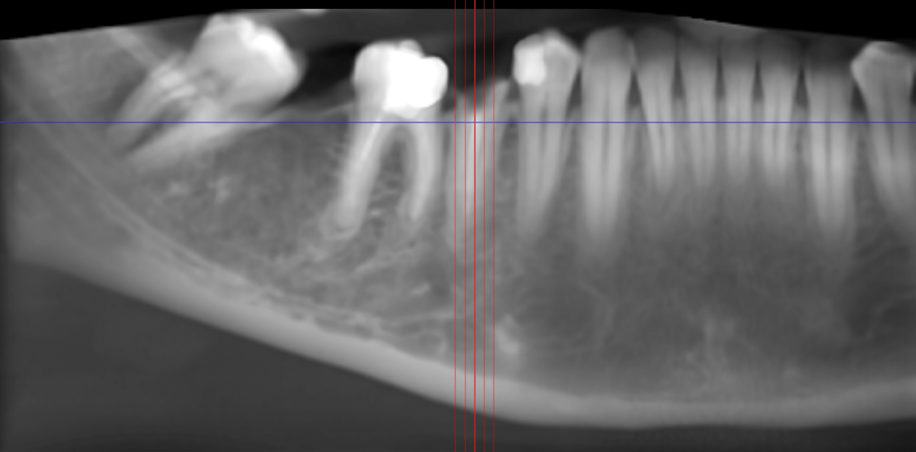 Cureus Combined Effect of PlateletRich Fibrin Matrix (PRFM) and