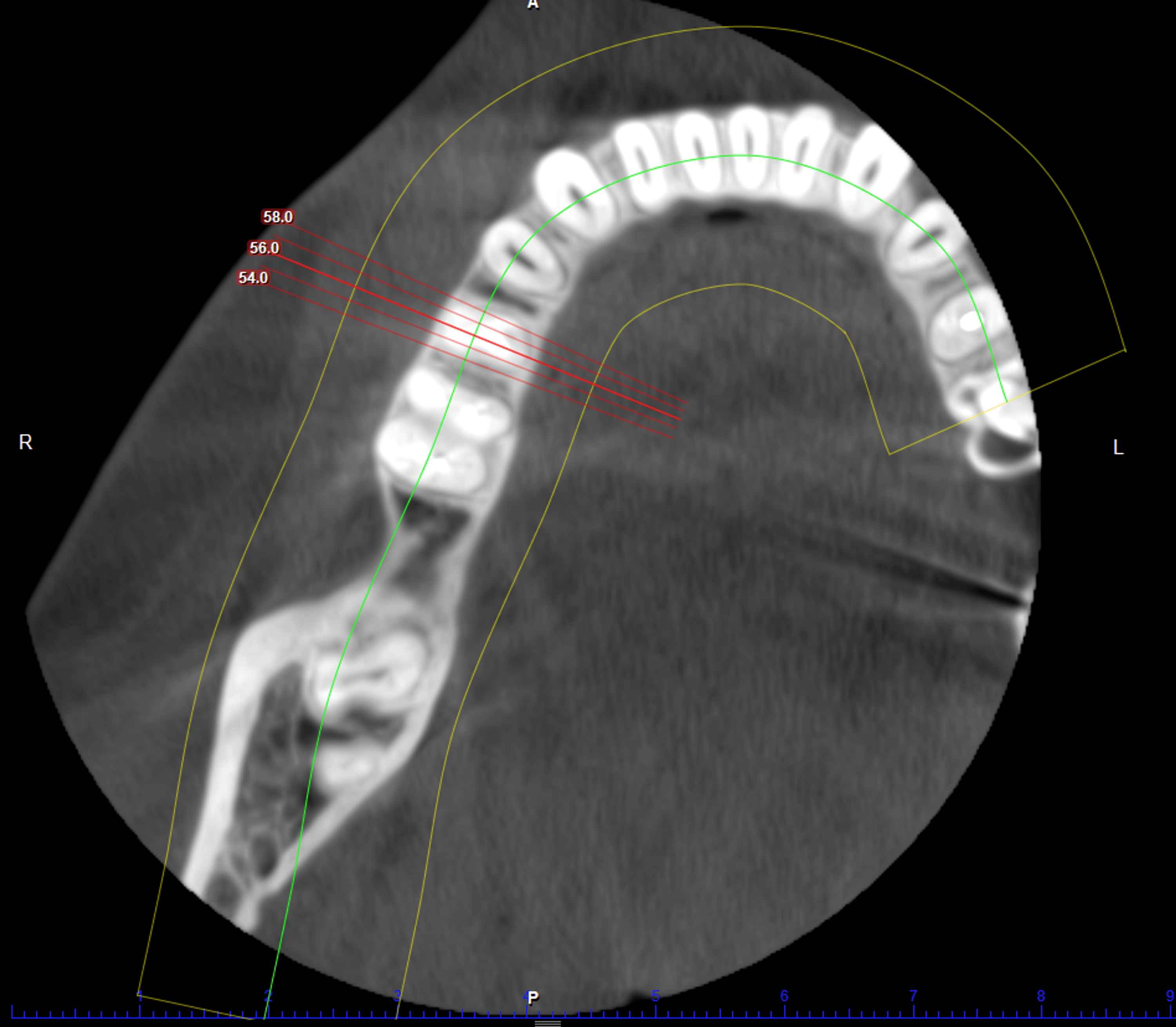Cureus Combined Effect of PlateletRich Fibrin Matrix (PRFM) and