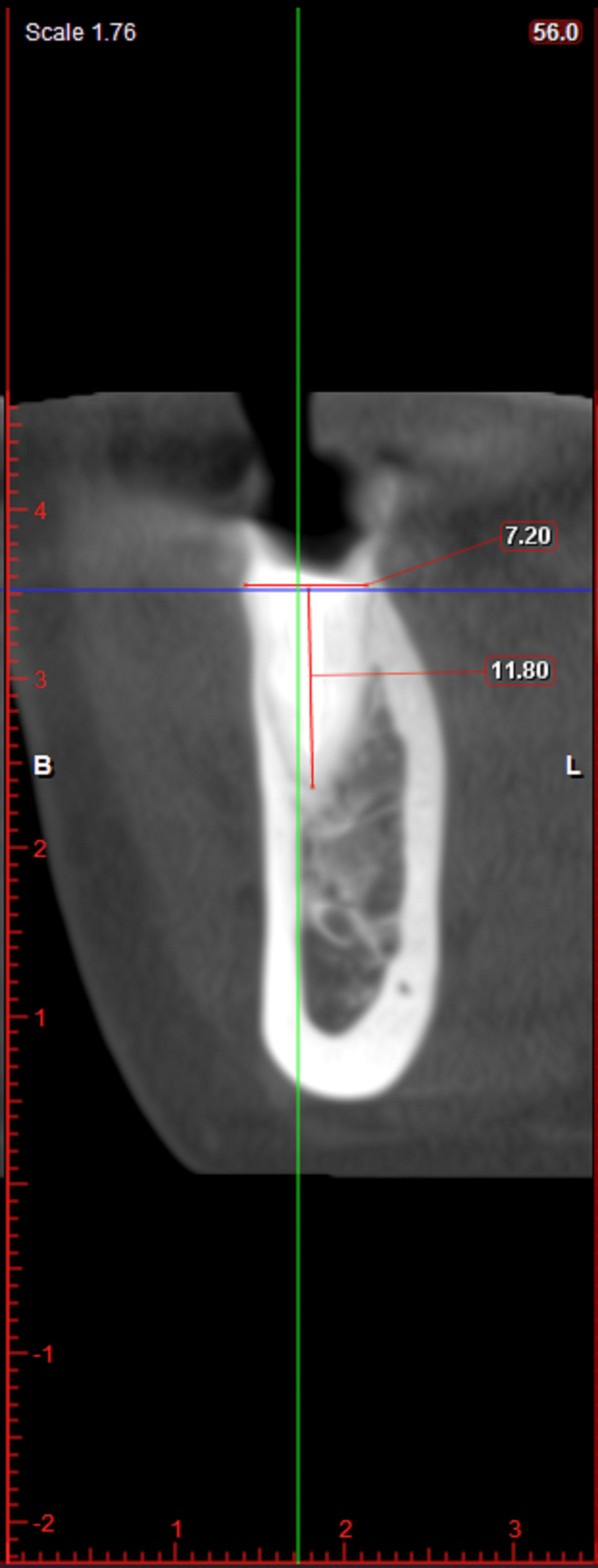 Cureus Combined Effect of PlateletRich Fibrin Matrix (PRFM) and