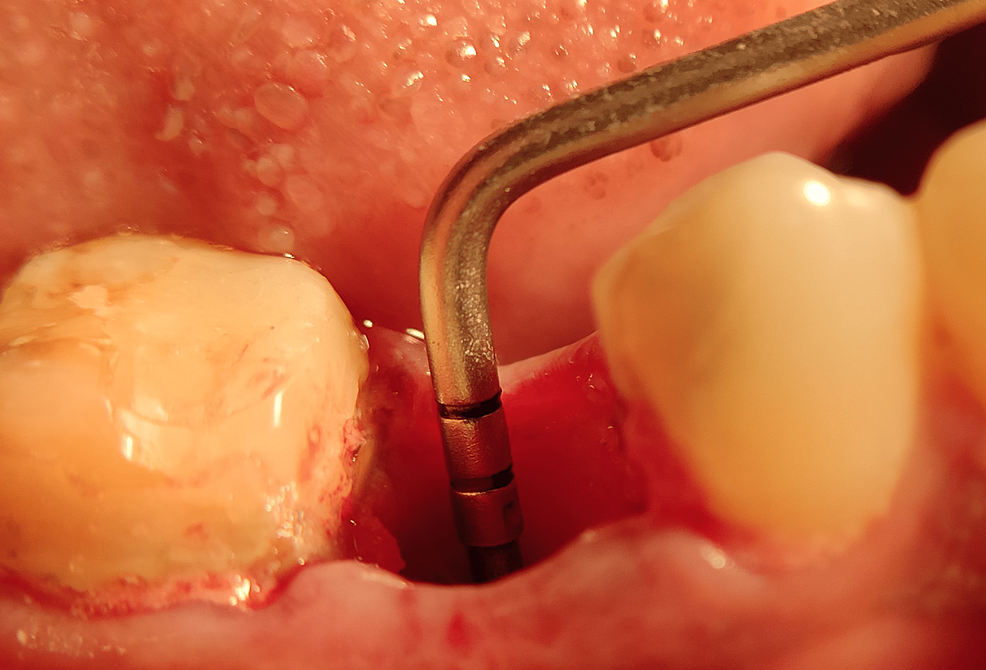 Cureus Combined Effect of PlateletRich Fibrin Matrix (PRFM) and