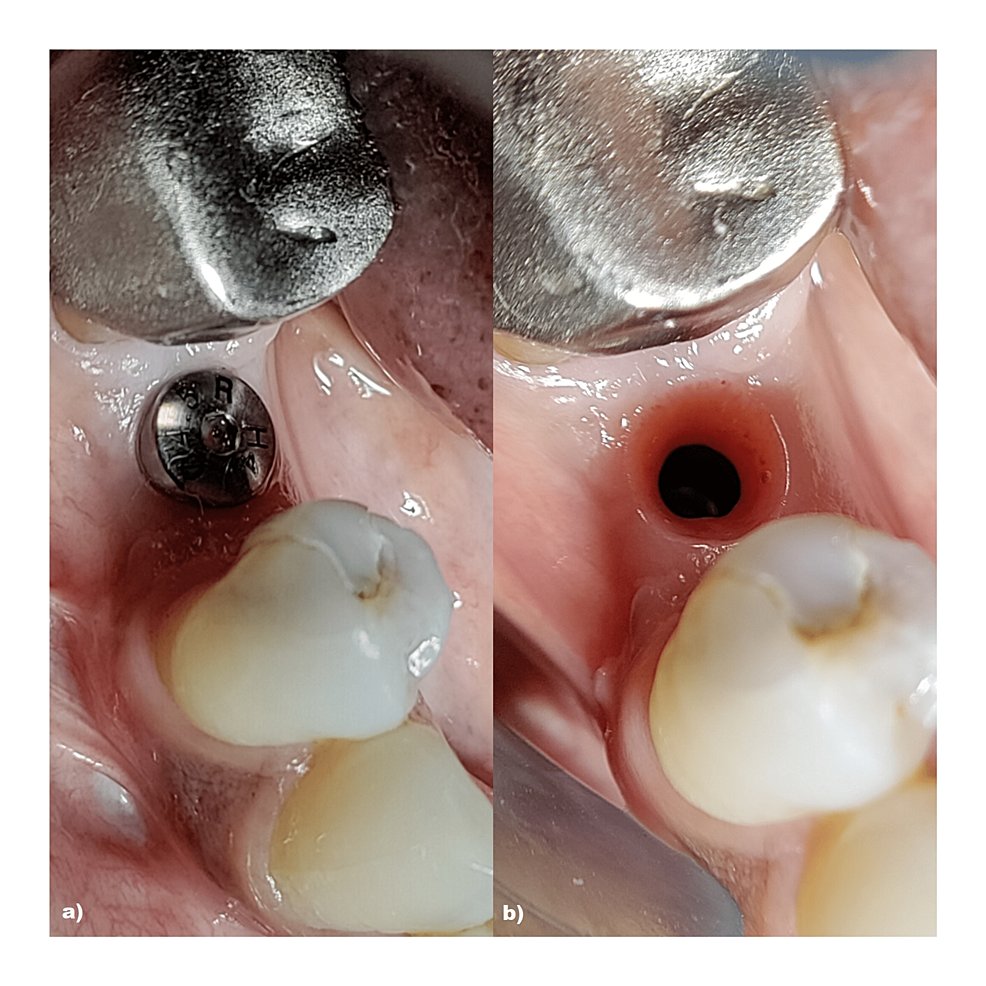 Cureus Combined Effect of PlateletRich Fibrin Matrix (PRFM) and