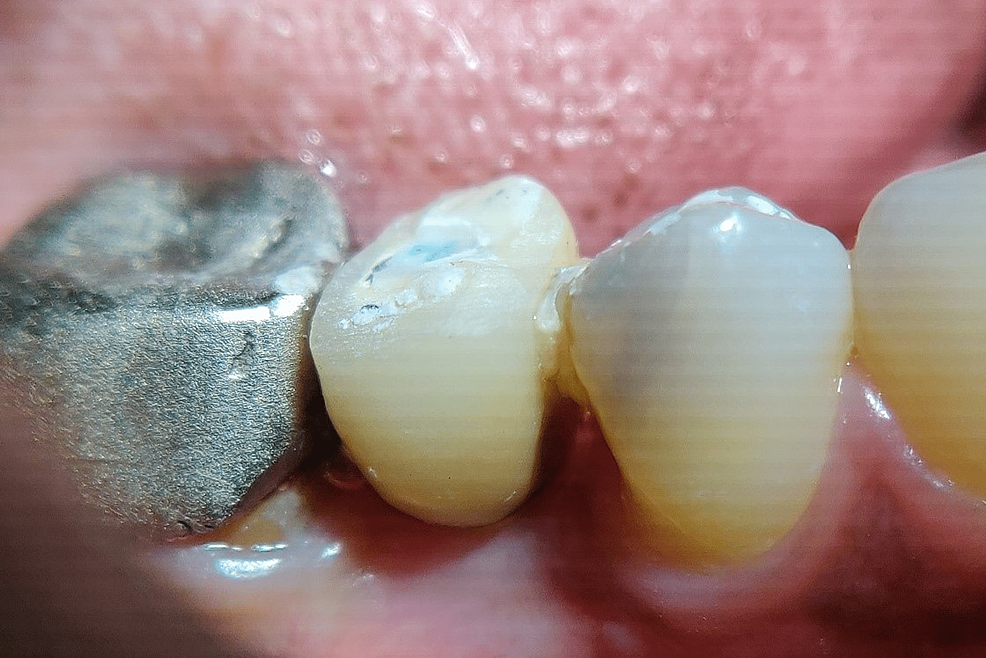 Cureus Combined Effect of PlateletRich Fibrin Matrix (PRFM) and