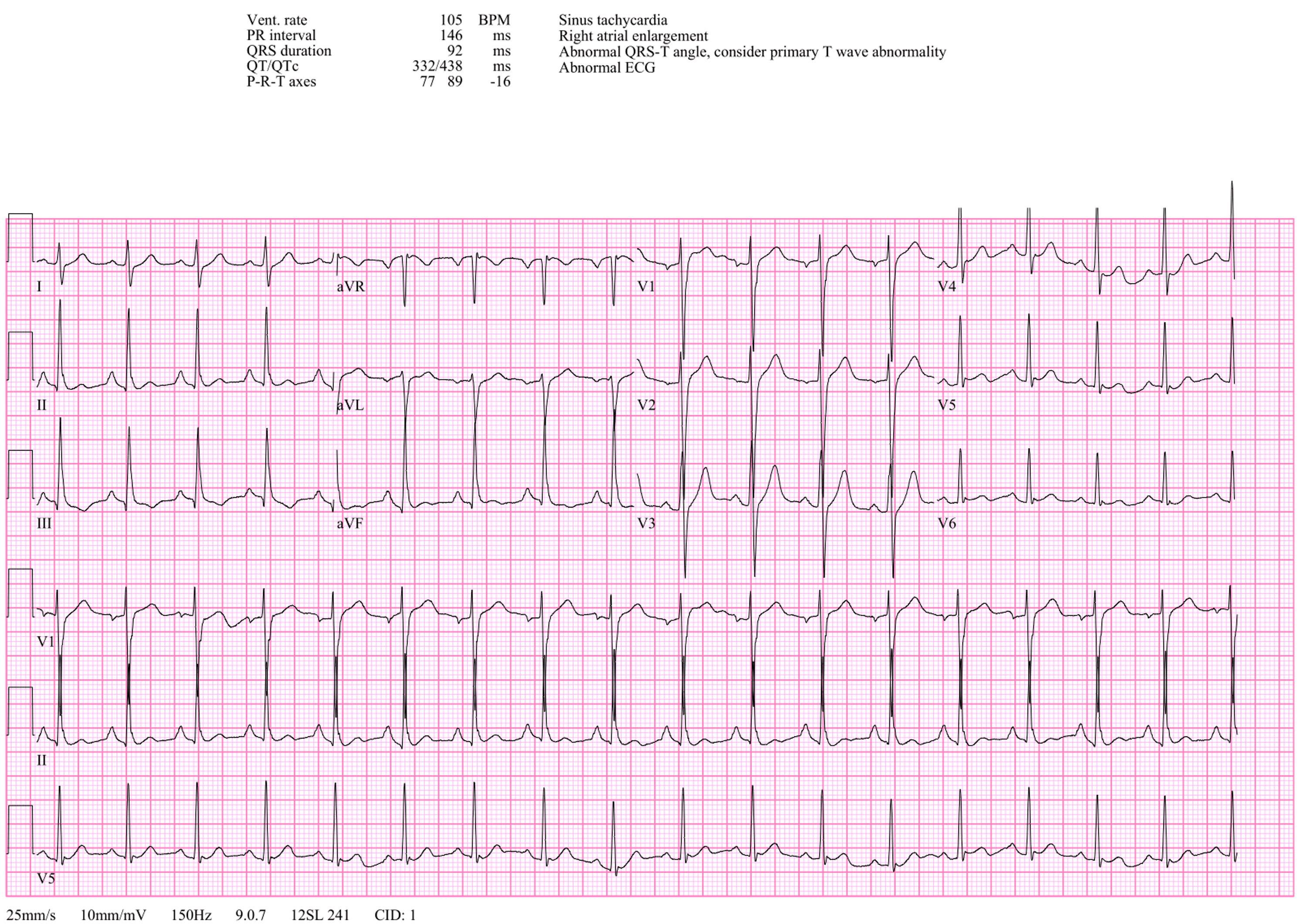 Cureus | Classic Presentation of Catecholaminergic Polymorphic ...