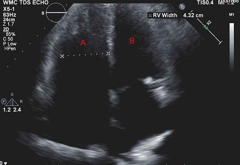 Preoperative-TTE-apical-four-chamber-view-showing-(A)-dilated-right-ventricle-with-increased-wall-thickness-and-(B)-left-ventricle