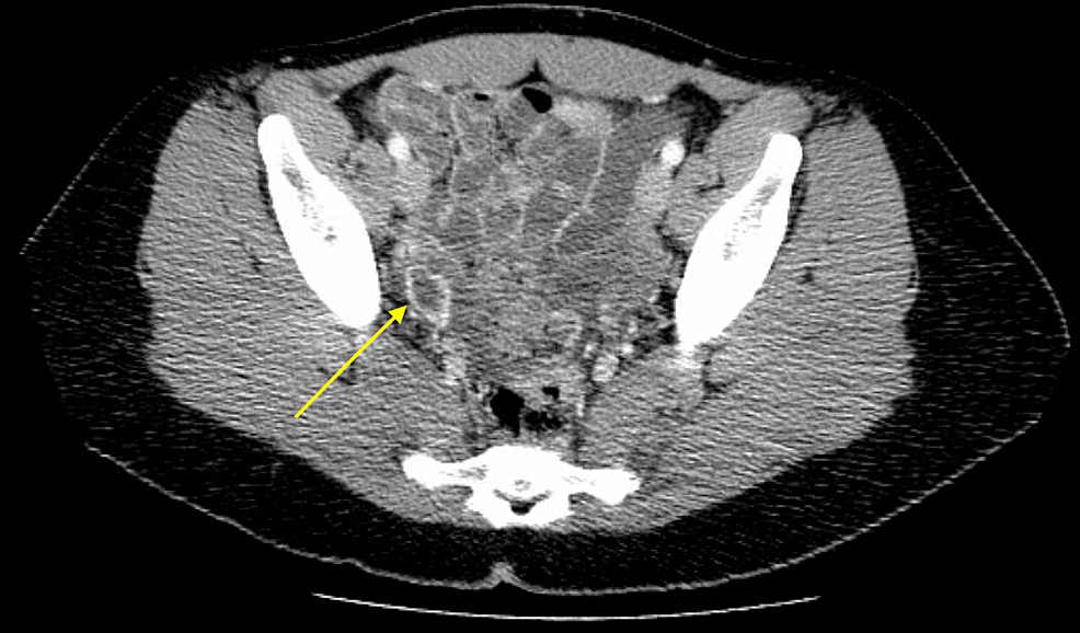 Computed-tomography-scan-of-the-abdomen-and-pelvis,-which-revealed-a-crenulated-right-ovarian-lesion-(indicated-by-the-yellow-arrow)