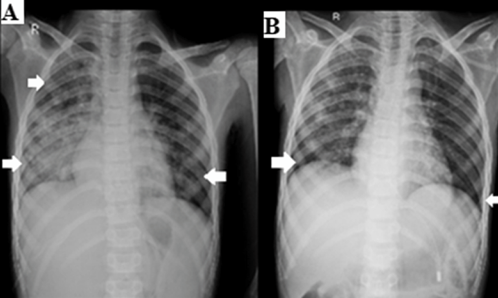 (A)-X-ray-of-the-chest-shows-consolidation-in-bilateral-lower-lobes-and-infiltrates-seen-in-upper-and-middle-lobes-indicating-an-infective-etiology.-(B)-Chest-x-ray-of-the-chest-after-two-months-of-respiratory-rehabilitation.