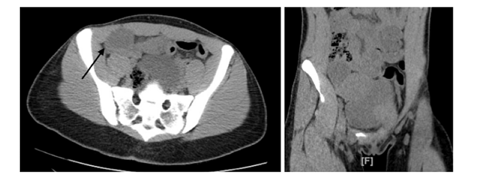 Torsion of paratubal cyst mimicking ovarian torsion: A rare case