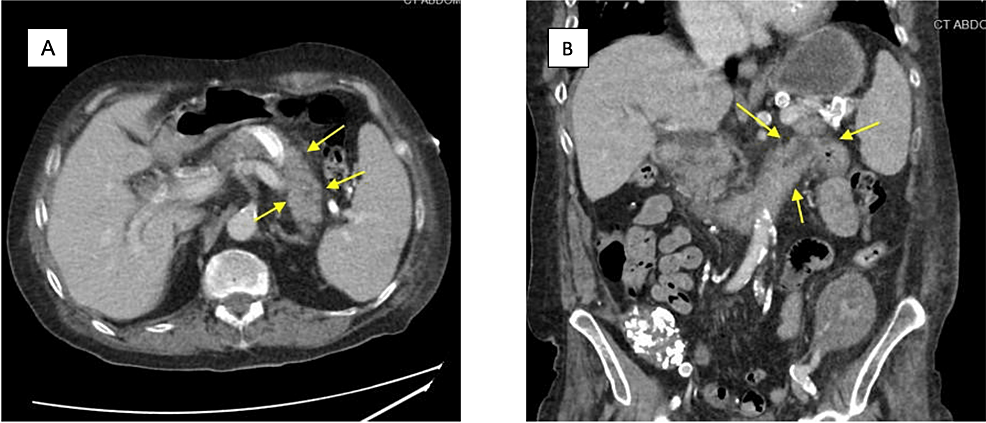 Cureus | Acute Pancreatitis in a Patient With Recent History of SARS ...