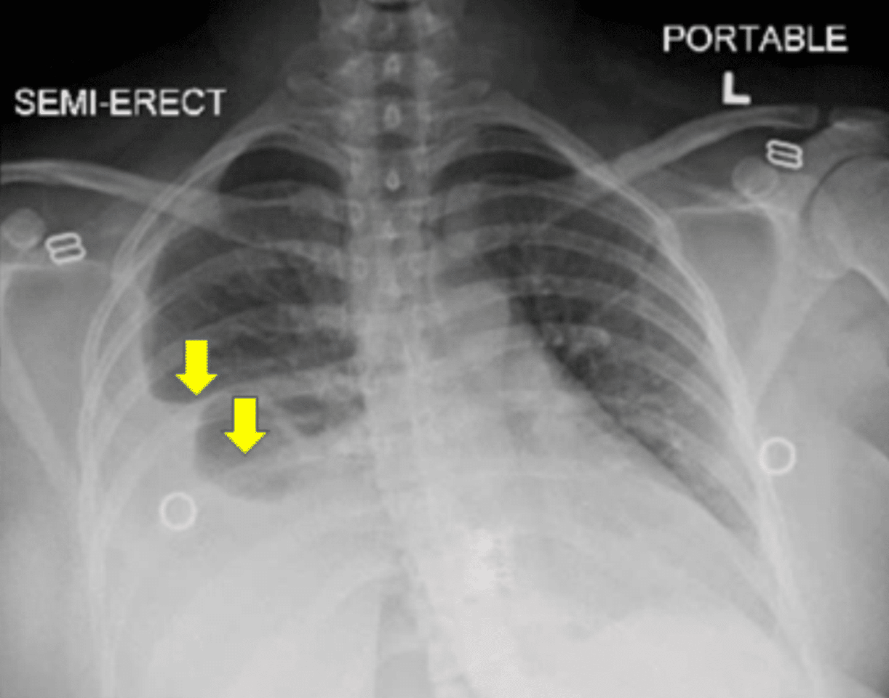 Cureus A Case Of Severe Ovarian Hyperstimulation Syndrome Causing Pleural Effusion 