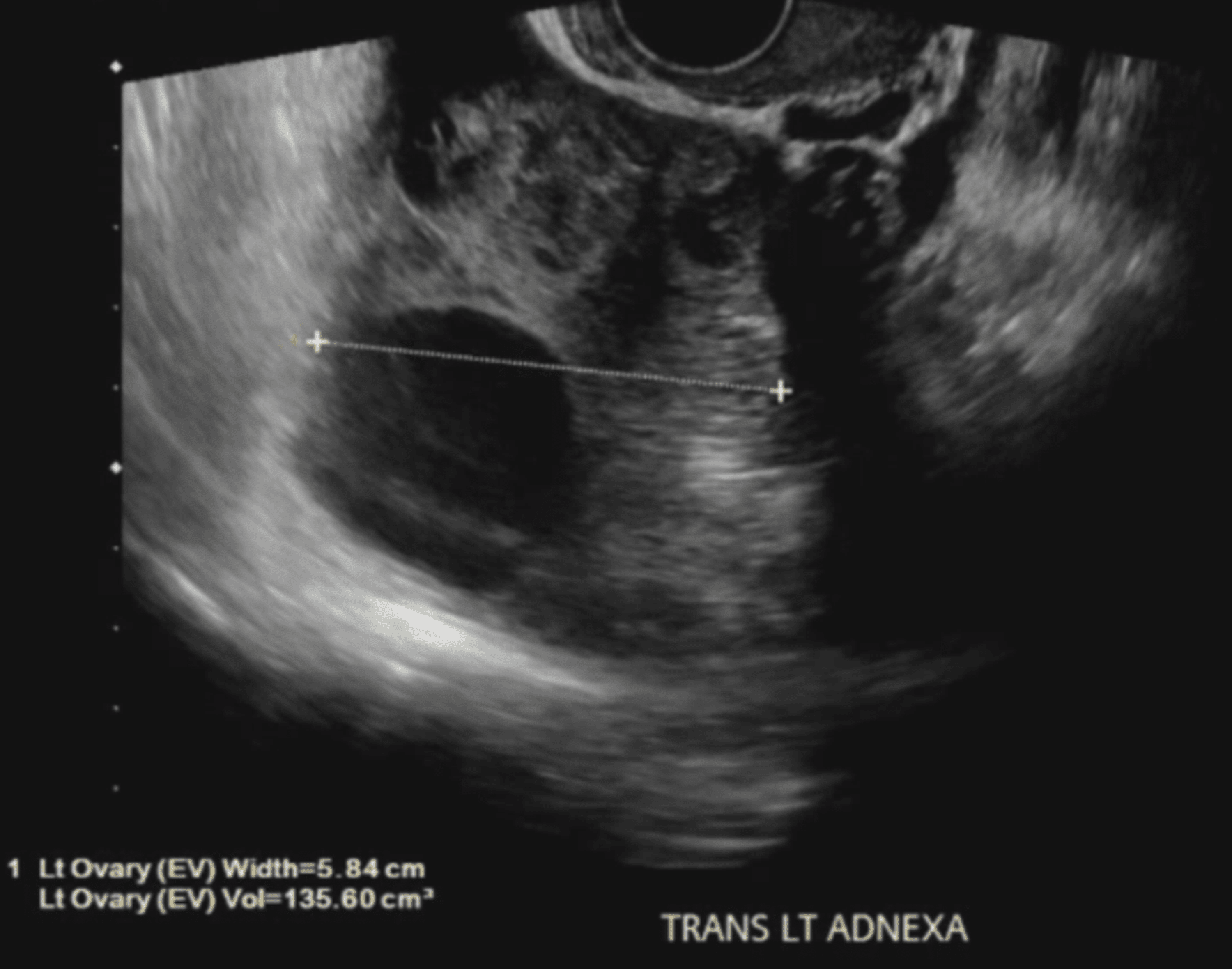 Cureus | A Case of Severe Ovarian Hyperstimulation Syndrome Causing ...