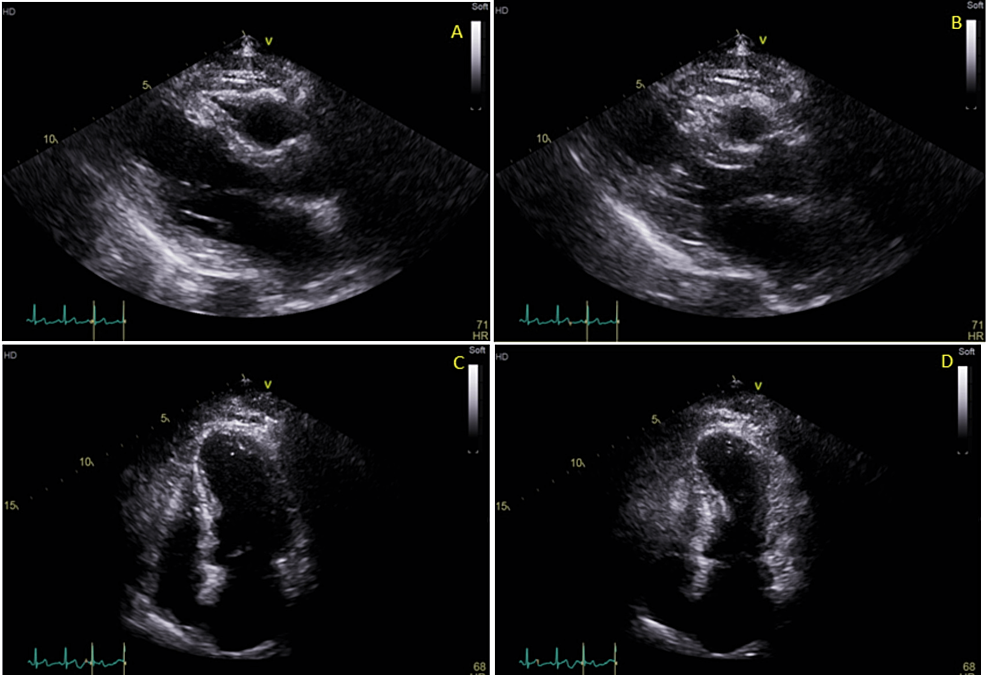 The-patient’s-transthoracic-echocardiogram