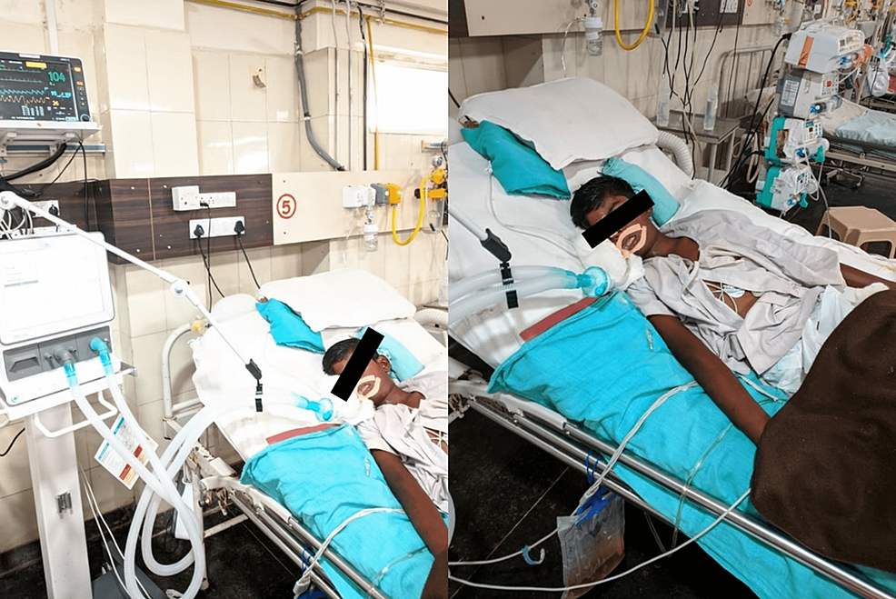 The-patient-on-the-day-of-assessment-on-a-ventilator.