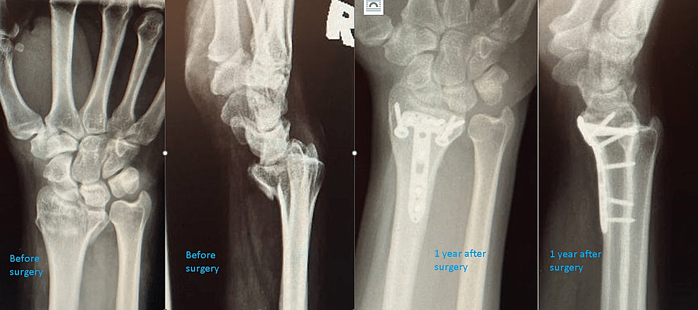 An-example-of-AO-23C3-distal-radius-fracture-treated-with-volar-rim-fixation-by-addressing-the-lunate-fossa-fragment