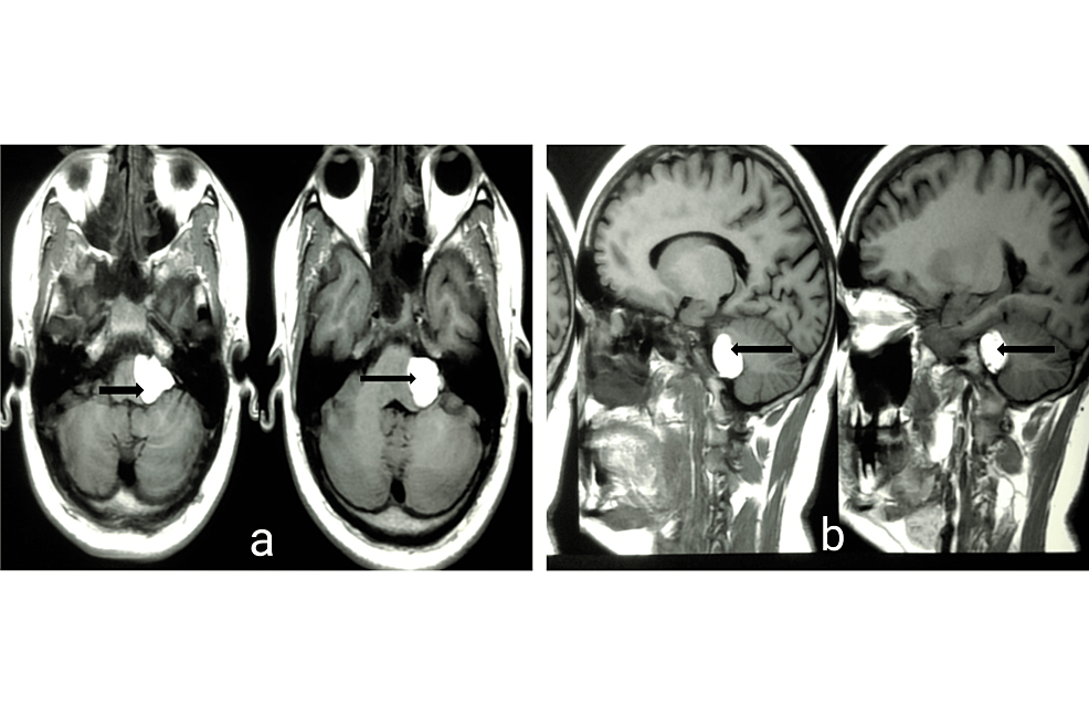Manejo quirúrgico de la parálisis del ángulo cerebeloso (CPA) que se presenta como neuralgia del trigémino: reporte de un caso