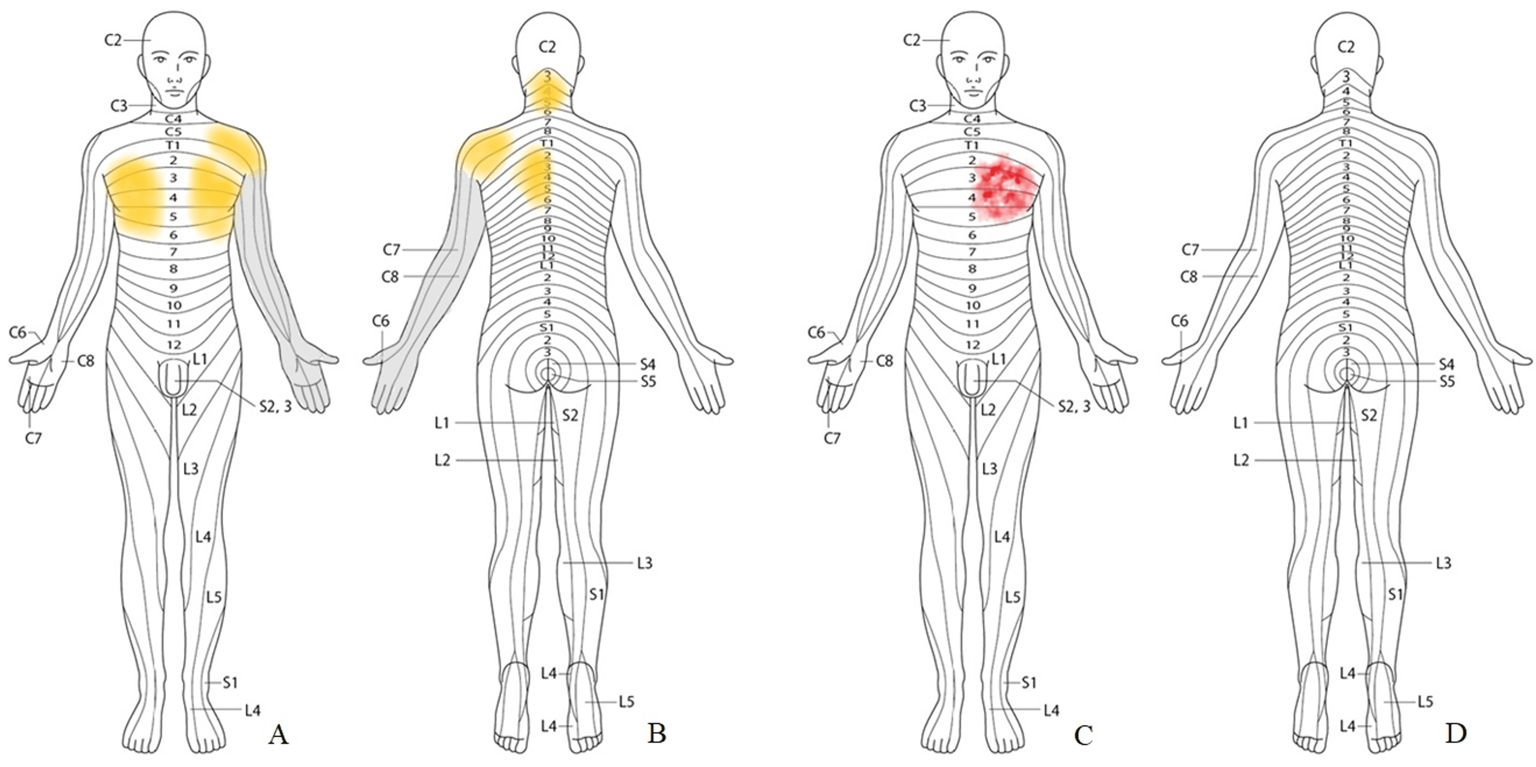 Cureus True Angina Pectoris Immediately After Cervical Disc Herniation Surgery For