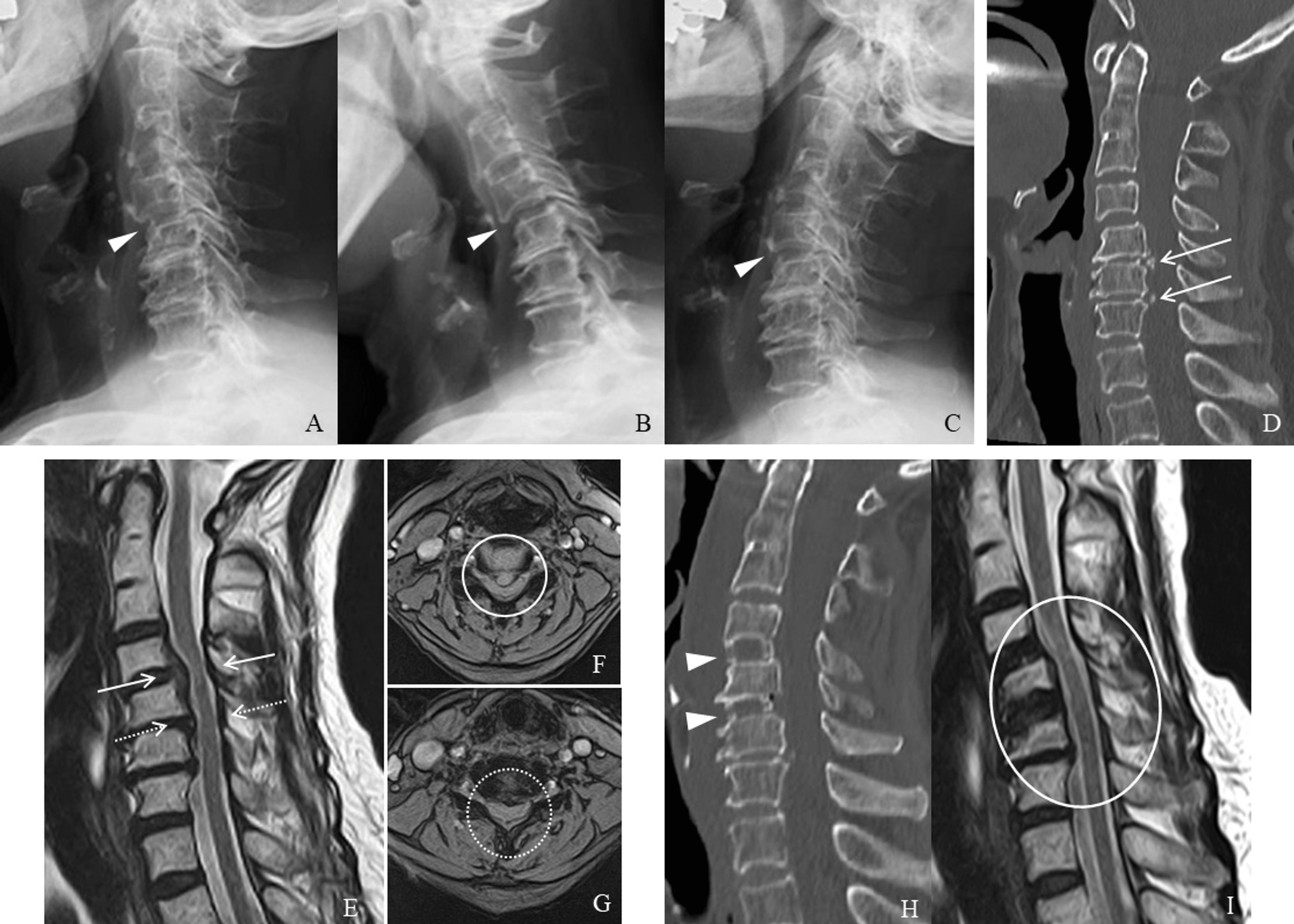 Cureus True Angina Pectoris Immediately After Cervical Disc