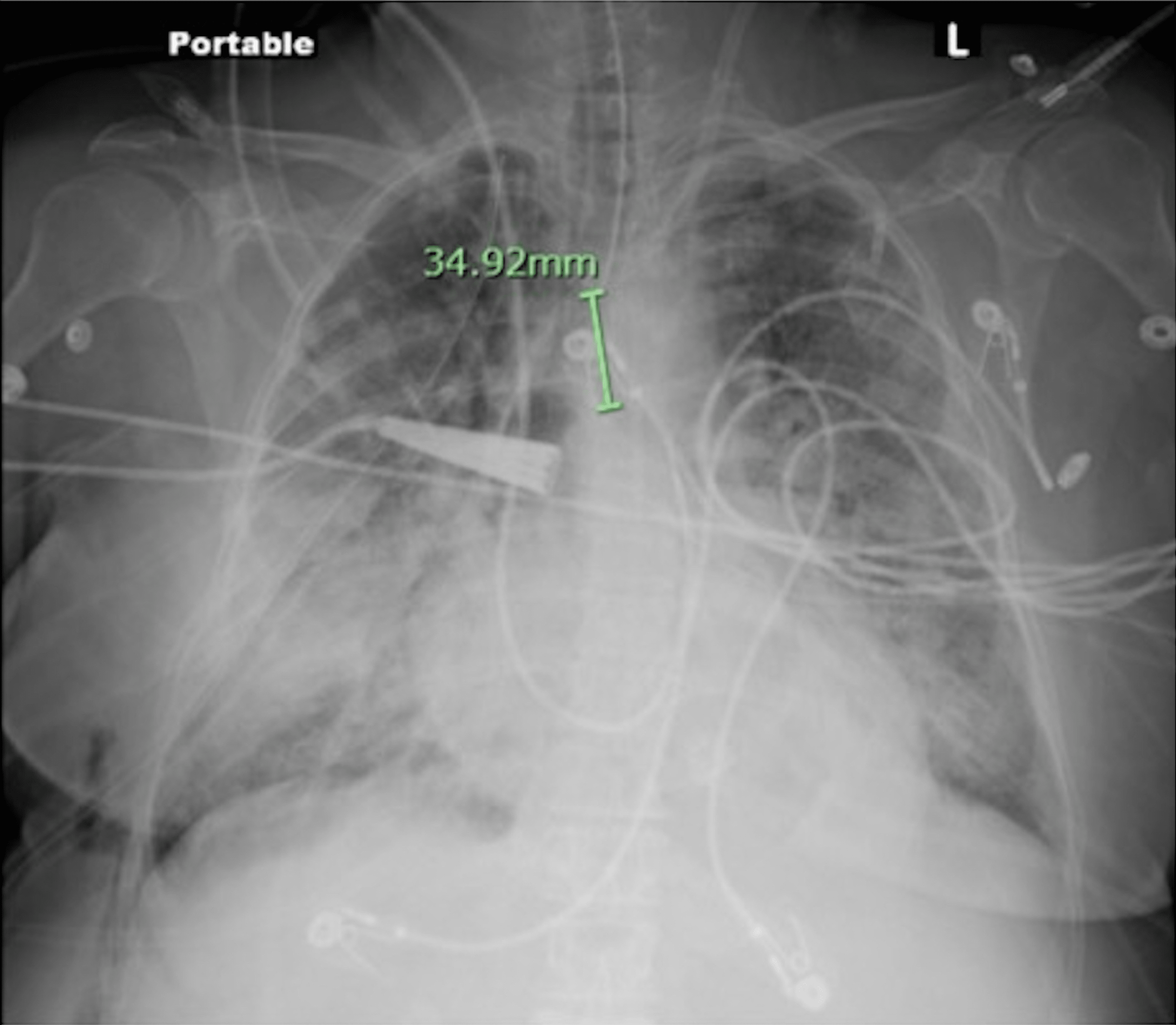 Cureus | Transfusion-Related Acute Lung Injury (TRALI) in Postoperative ...