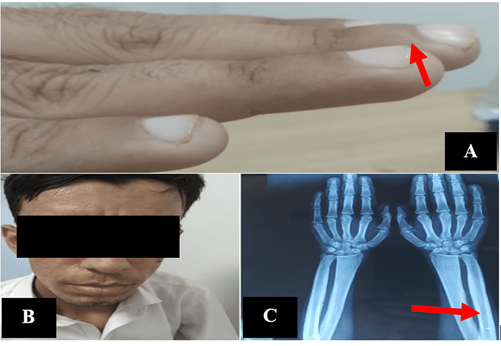 A:-Patient-zeigt-Keuleschlagen,-B:-Patient-zeigt-Frontal-Bossing,-hervorstehender-Kiefer,-C:-Patient-zeigt-erhöhte-Knochendichte