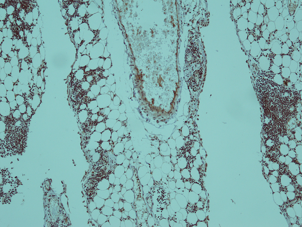 Immunohistochemical-stain-for-Tdt-showed-nuclear-positivity-in-blast-cells-(x-10).