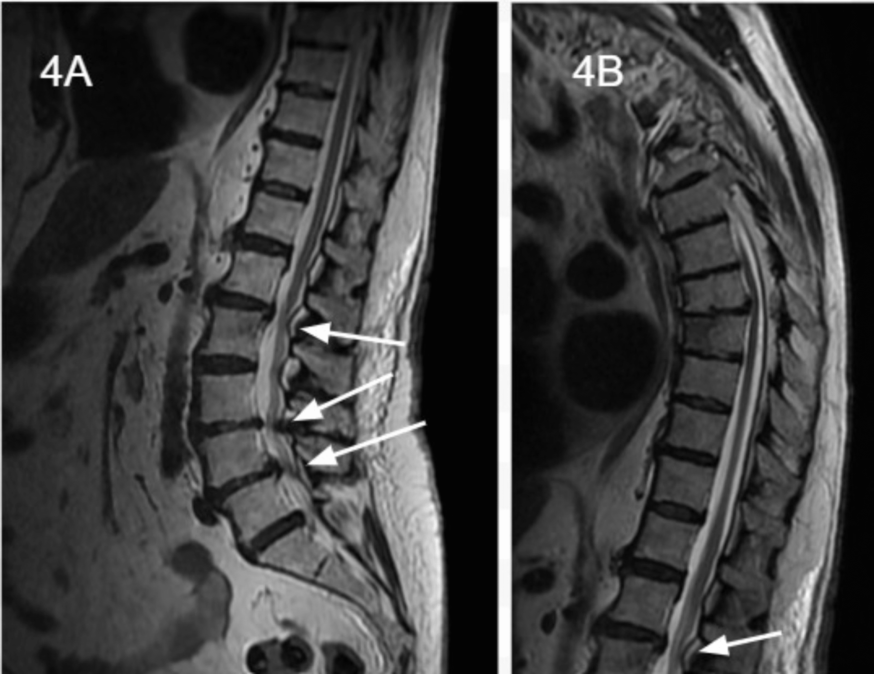 Cureus | A Case Of Delayed Treatment In Cervical Spondylotic Myelopathy ...