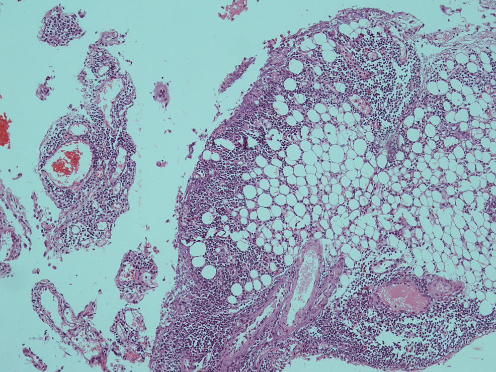 Haematoxylin-and-eosin-(H&E)-section-of-omental-biopsy-showed-infiltration-of-fatty-tissue-by-neoplastic-blast-cells-(×-10).