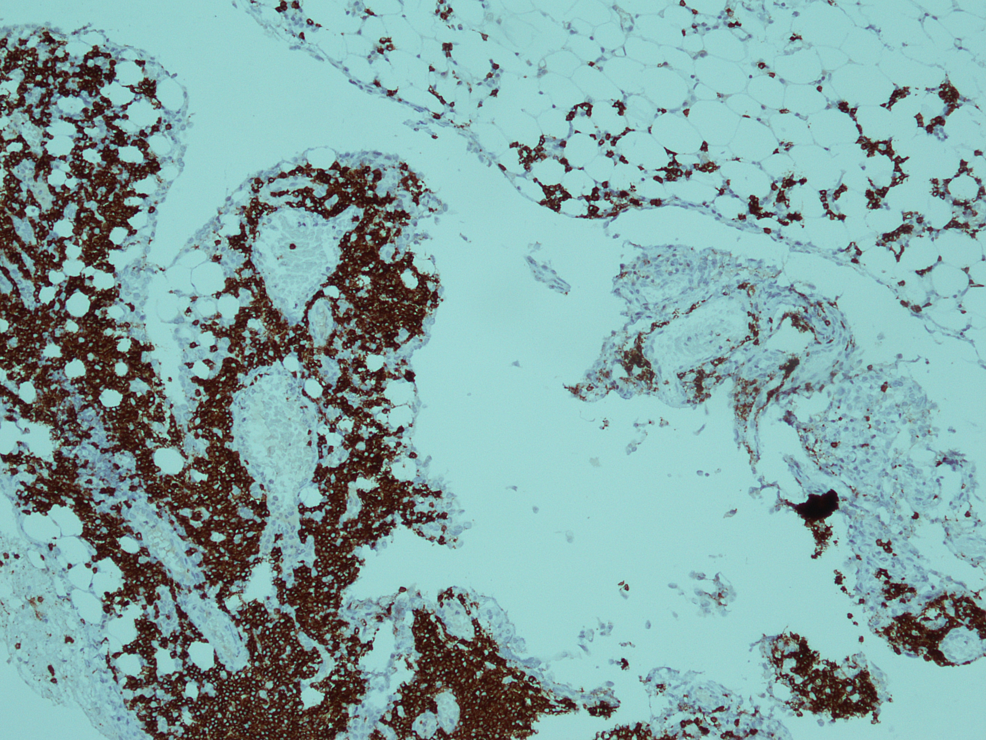 Immunohistochemical-stain-for-CD20-showed-membranous-positivity-in-blast-cells-(x-40).