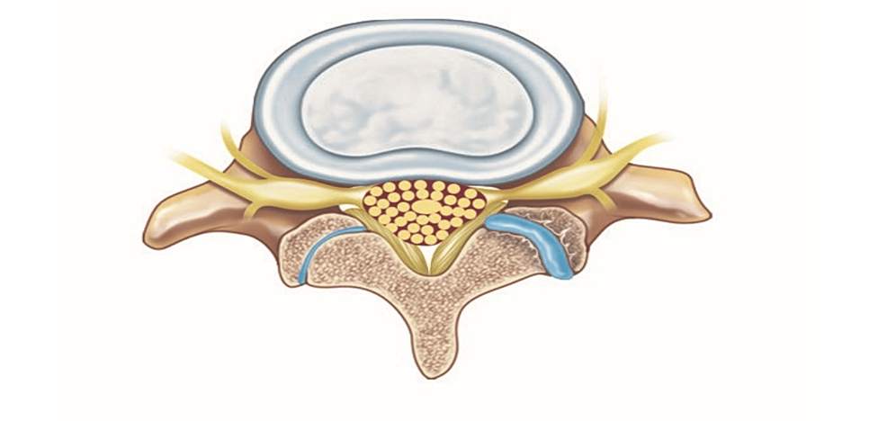 Excessive Fluid in the Lumbar Facet Joint as a Predictor of ...