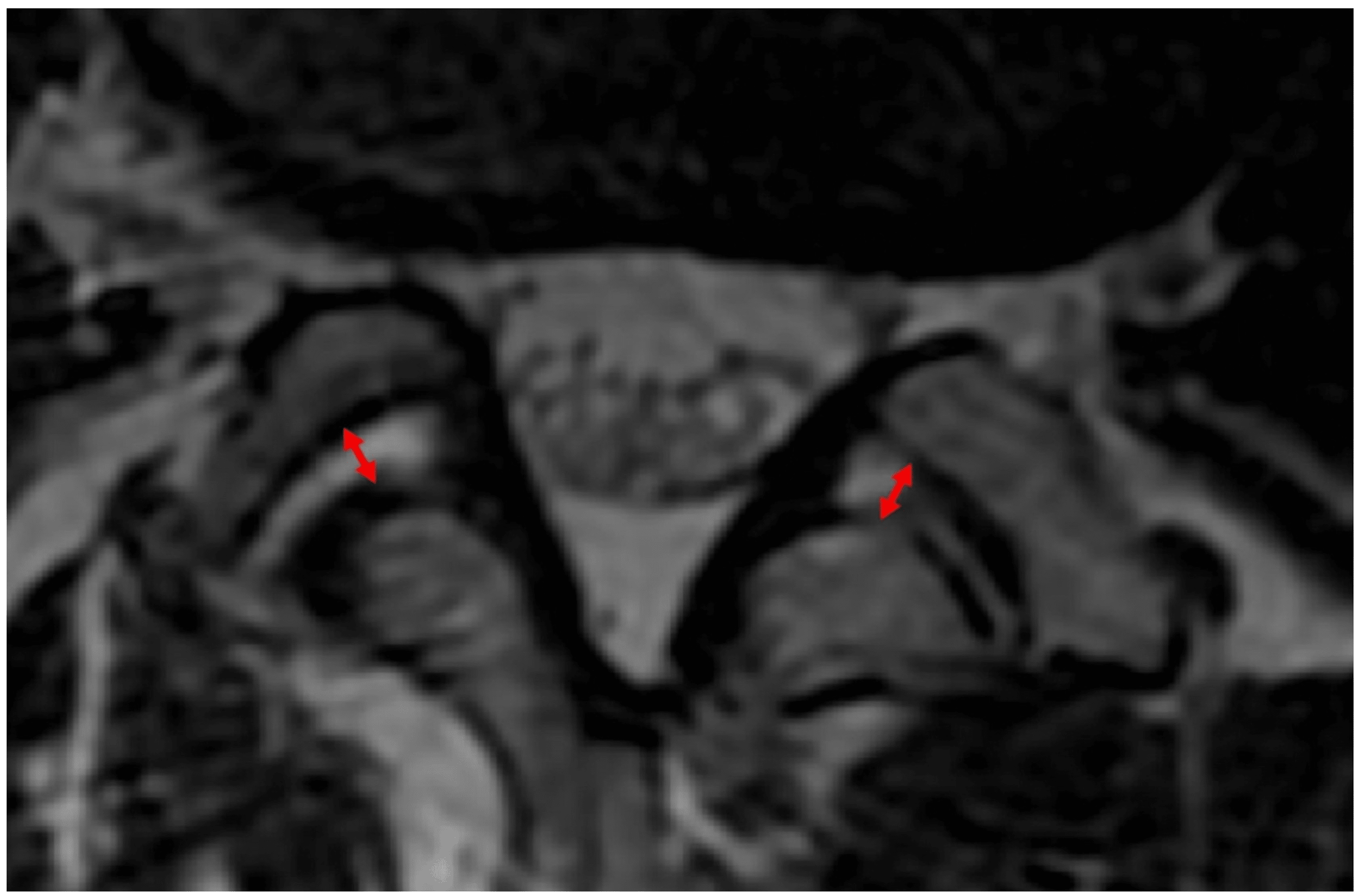 Cureus | Excessive Fluid in the Lumbar Facet Joint as a Predictor of ...