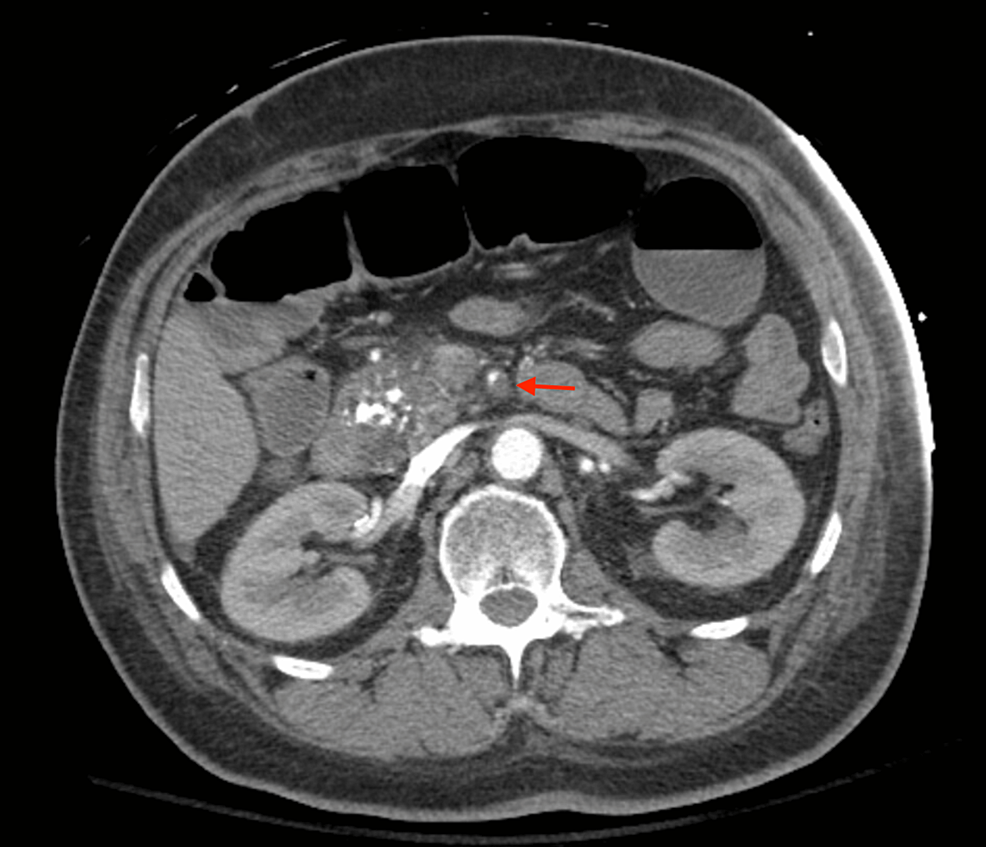 Diabetic Ketoacidosis And Acute Mesenteric Ischemia In Adults An 