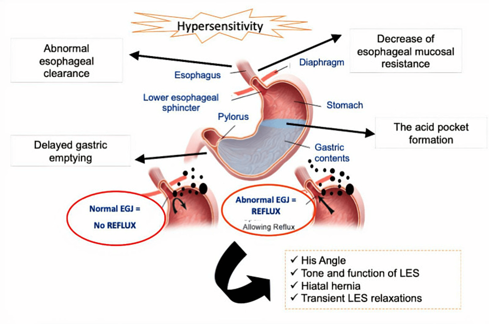 Atypical symptoms of gastroesophageal reflux in pregnancy