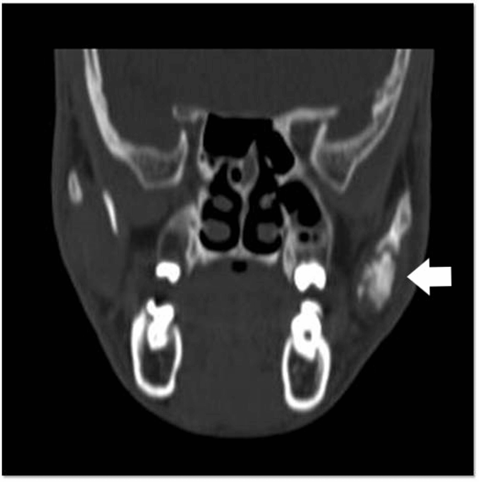 Cureus Giant Osteoma of Zygoma Mimicking PseudoTemporoMandibular