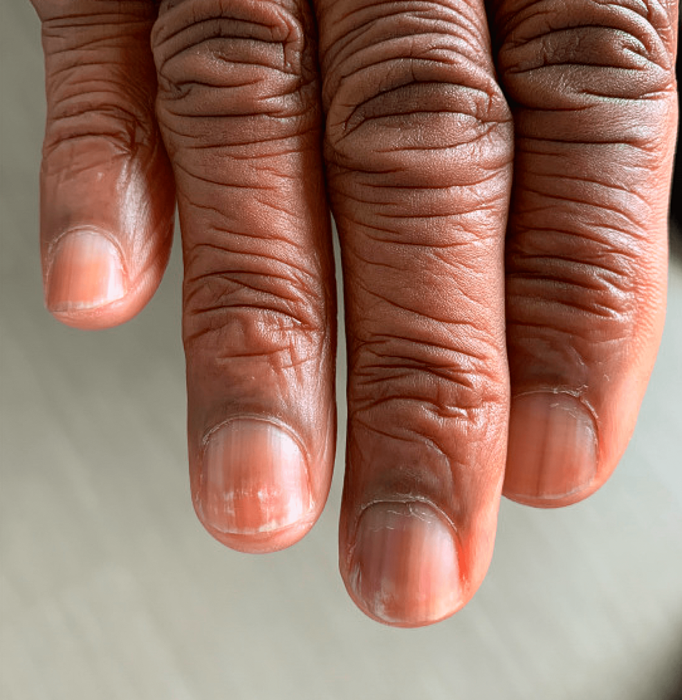 Cureus Dystrophic Nails An Unusual Clue to Recurrent Lymphoma