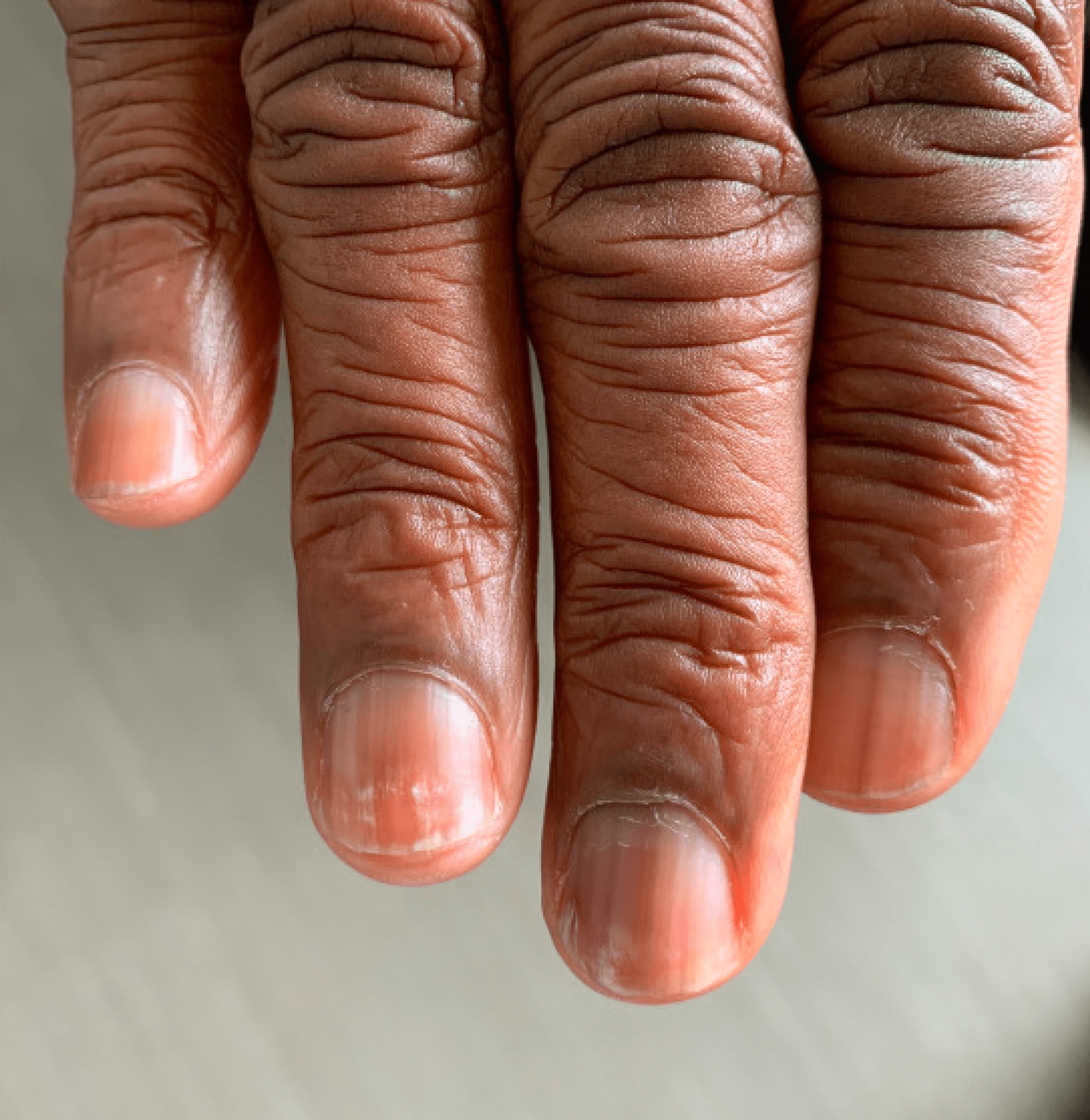 Cureus | Dystrophic Nails: An Unusual Clue to Recurrent Lymphoma | Article